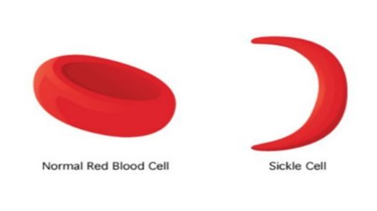 Sickle cell disease - blood structure