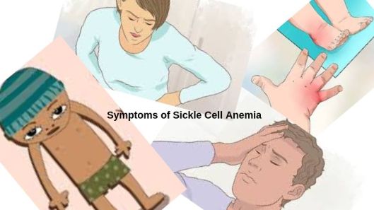 Sickle cell disease - Symptoms