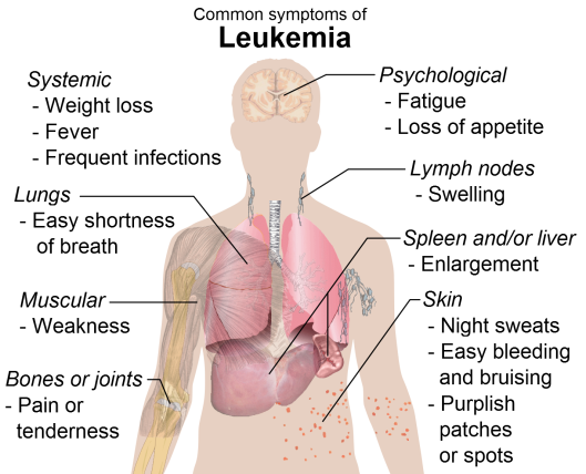 Symptoms of Leukemia
